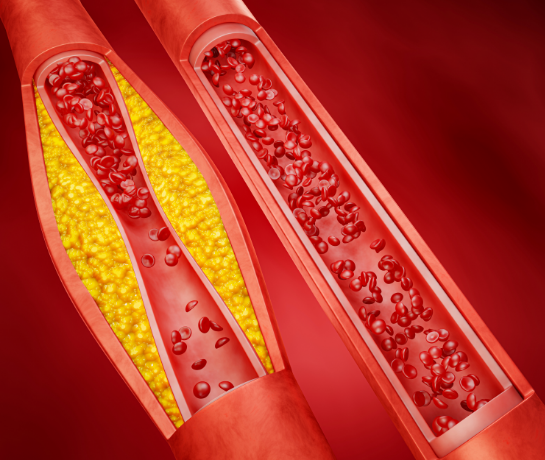 Enfermedades cardiovasculares: factores de riesgo y su prevención - Apoteca Natura